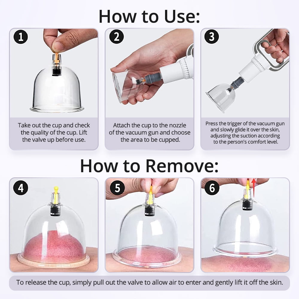 Suction Cupping Therapy _ Types of Cupping Therapy Explained – JGJR