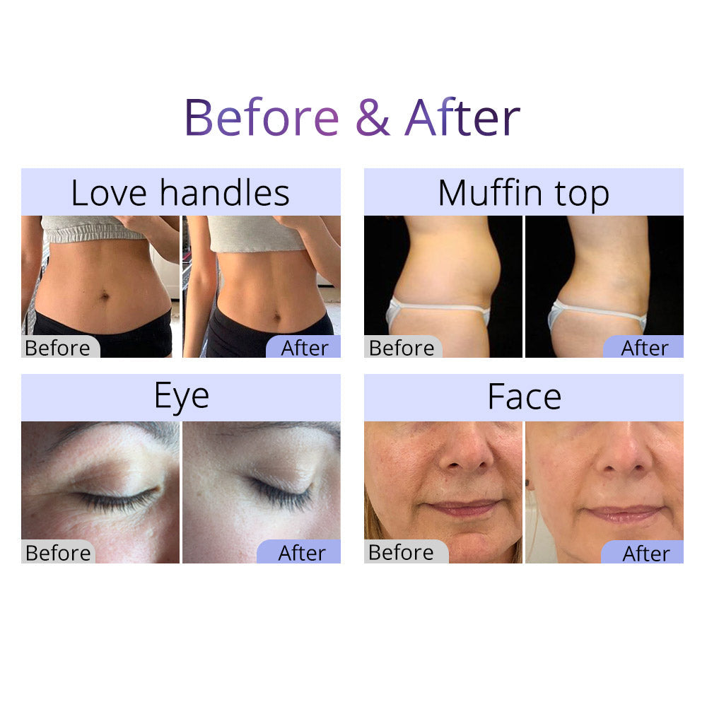 cavitation before and after photos