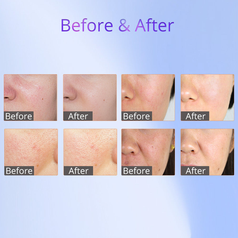 radio frequency facial before after