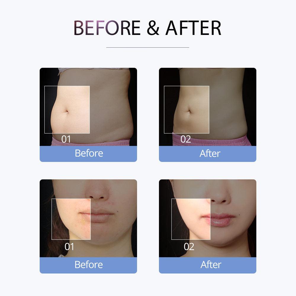 cavitation treatment before after