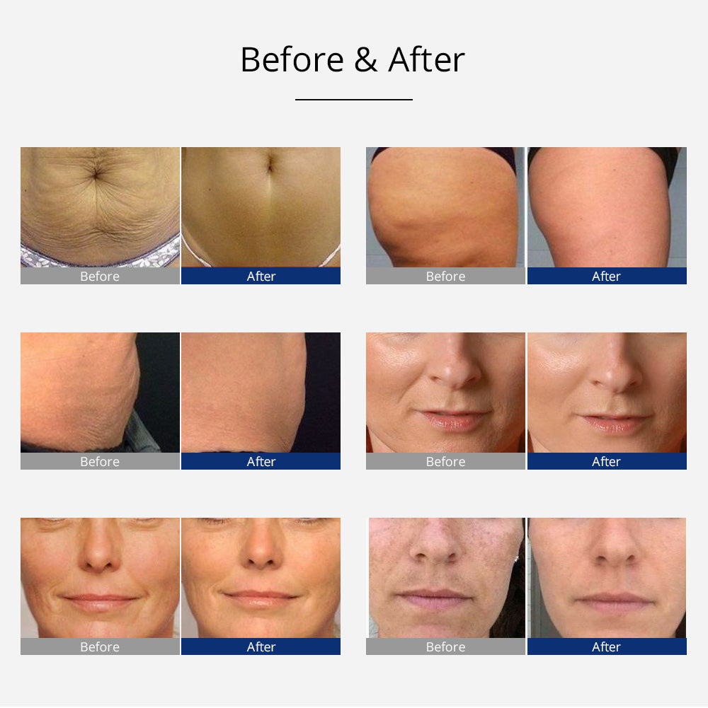 rf cavitation before and after
